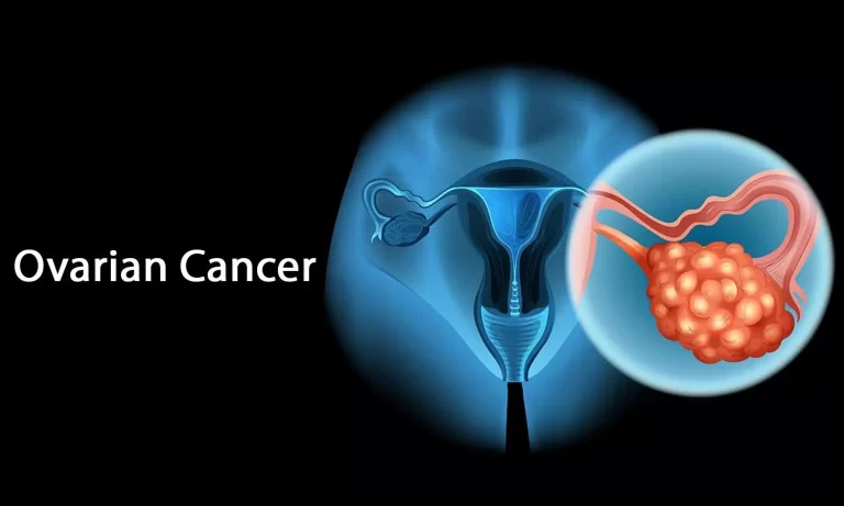 Diet and Lifestyle Changes During Ovarian Cancer Treatment: What You Need to Know