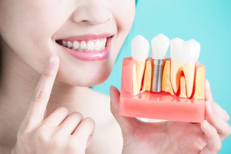 A Comprehensive Guide To The Cost And Lifespan Of Dental Implants